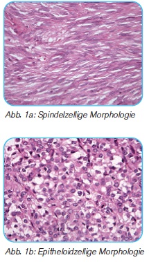 GIST Zellen Morphologie